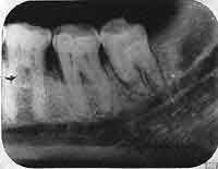 Radiografia de diente